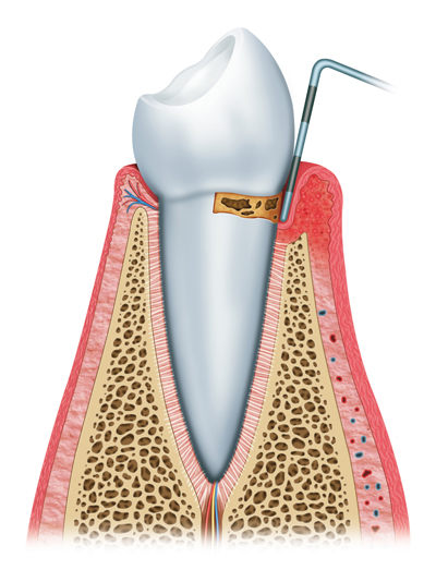 Gingivitis